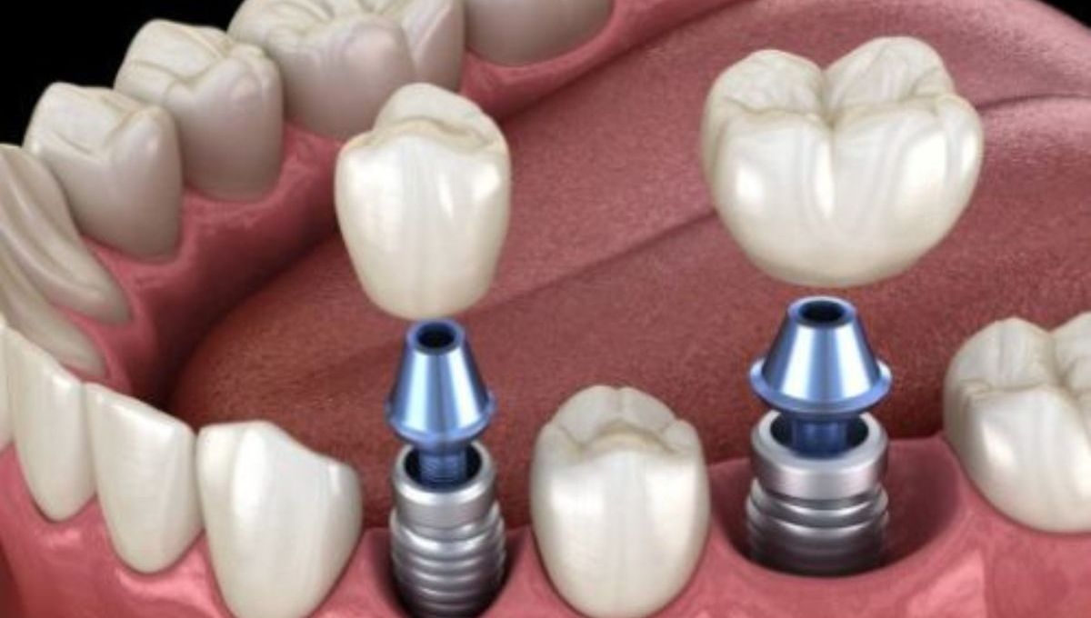 Dental Implants Medicine Hat