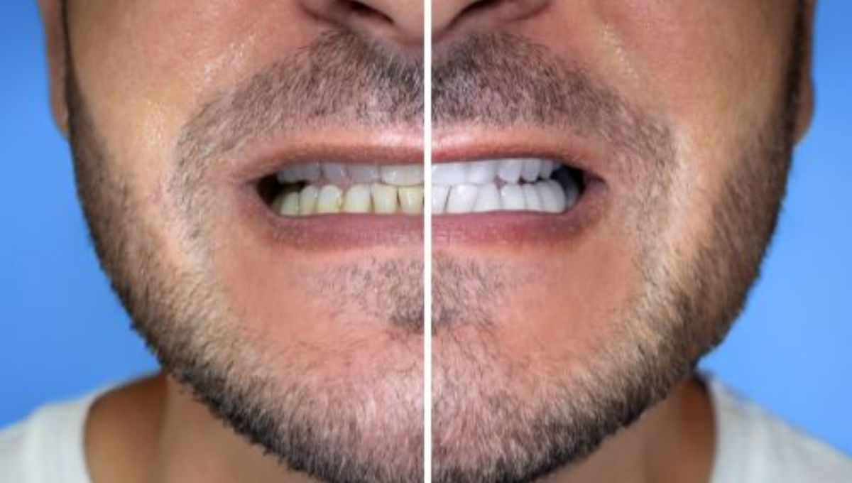 Teeth Whitening Medicine Hat